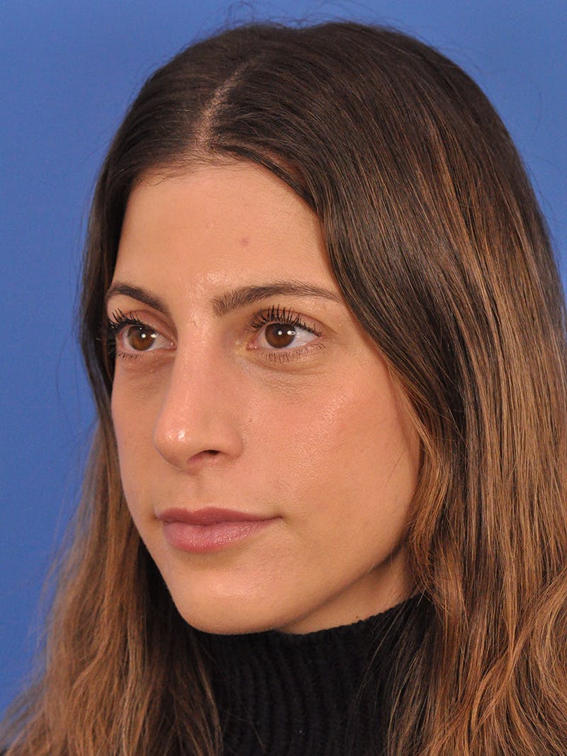 Rhinoplasty Before & After Gallery - Patient 574327 - Image 7