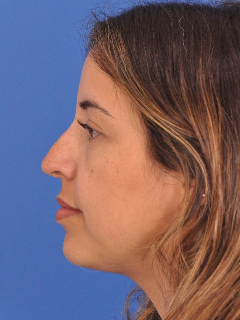 Rhinoplasty Before & After Gallery - Patient 277111 - Image 9