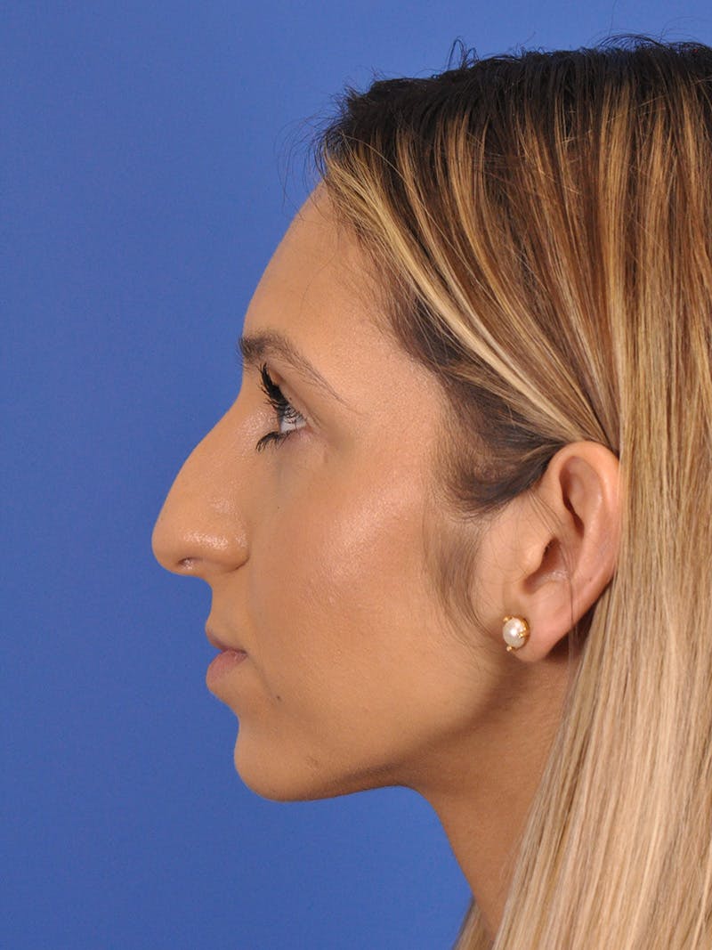 Rhinoplasty Before & After Gallery - Patient 587792 - Image 11