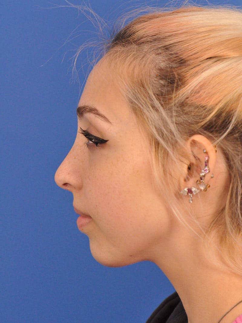 Rhinoplasty Before & After Gallery - Patient 192652 - Image 12