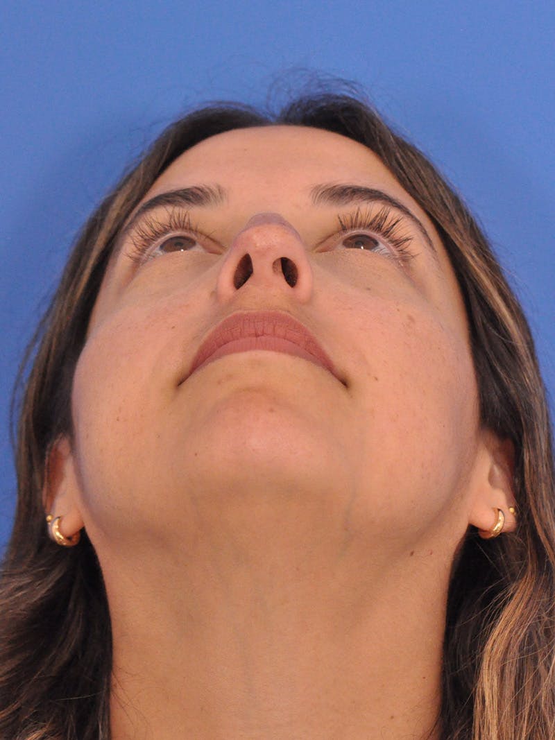 Rhinoplasty Before & After Gallery - Patient 277111 - Image 11