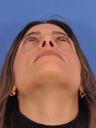 Rhinoplasty Before & After Gallery - Patient 574327 - Image 12