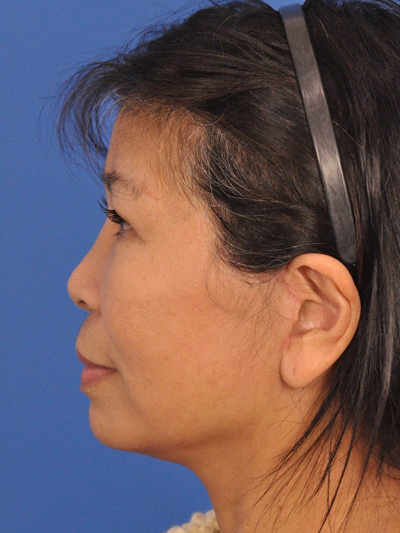 Facelift Before & After Gallery - Patient 227711 - Image 10