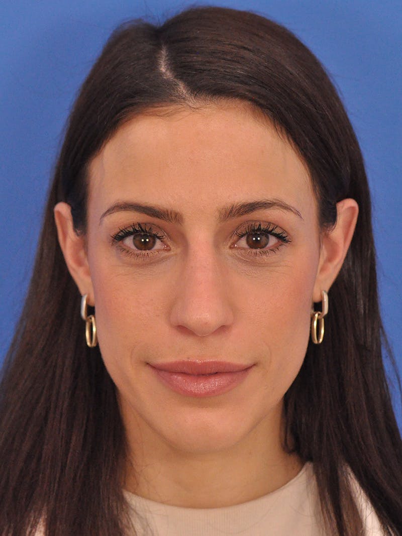 Rhinoplasty Before & After Gallery - Patient 100951 - Image 5