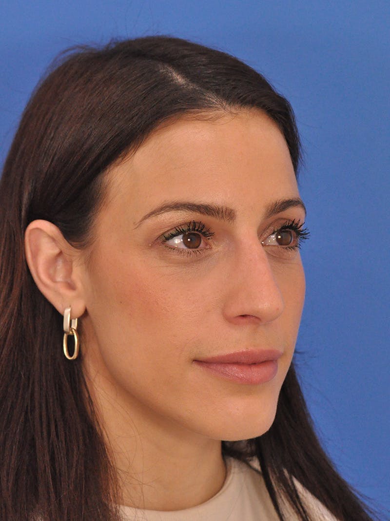 Rhinoplasty Before & After Gallery - Patient 100951 - Image 3