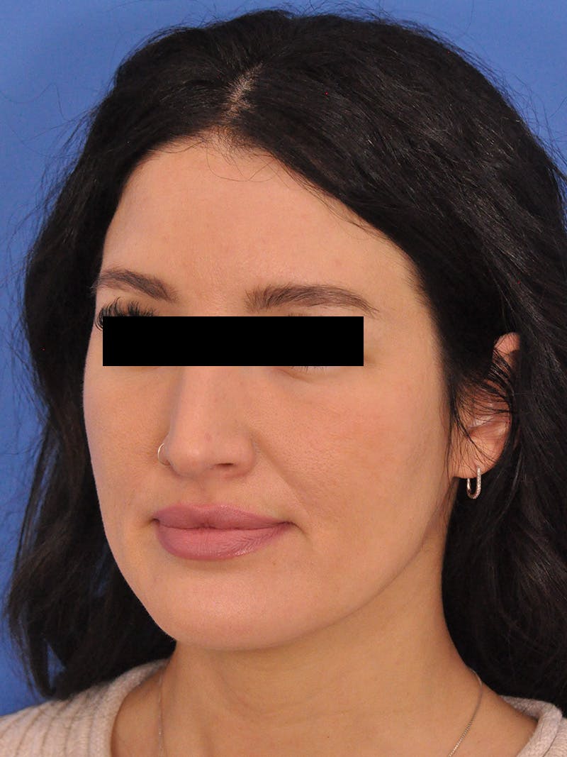 Brow Lift Before & After Gallery - Patient 233430 - Image 3