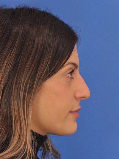 Rhinoplasty Before & After Gallery - Patient 574327 - Image 1