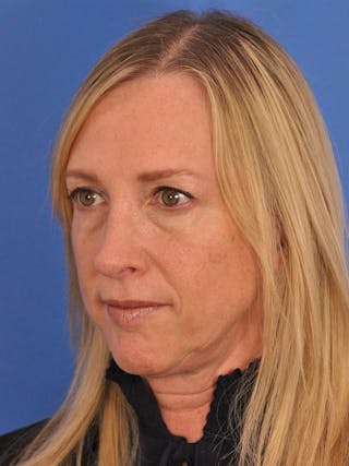 Rhinoplasty Before & After Gallery - Patient 315321 - Image 10