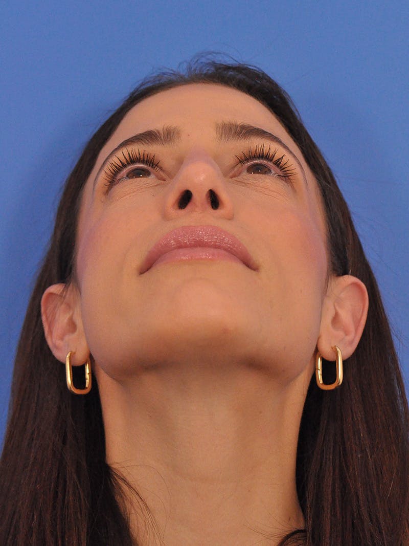Rhinoplasty Before & After Gallery - Patient 100951 - Image 12