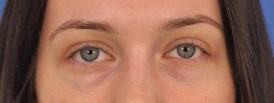 Tear Trough Filler Before & After Gallery - Patient 401813 - Image 1