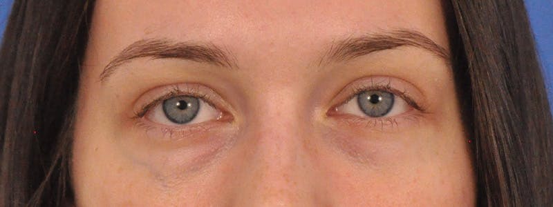 Tear Trough Filler Before & After Gallery - Patient 401813 - Image 1