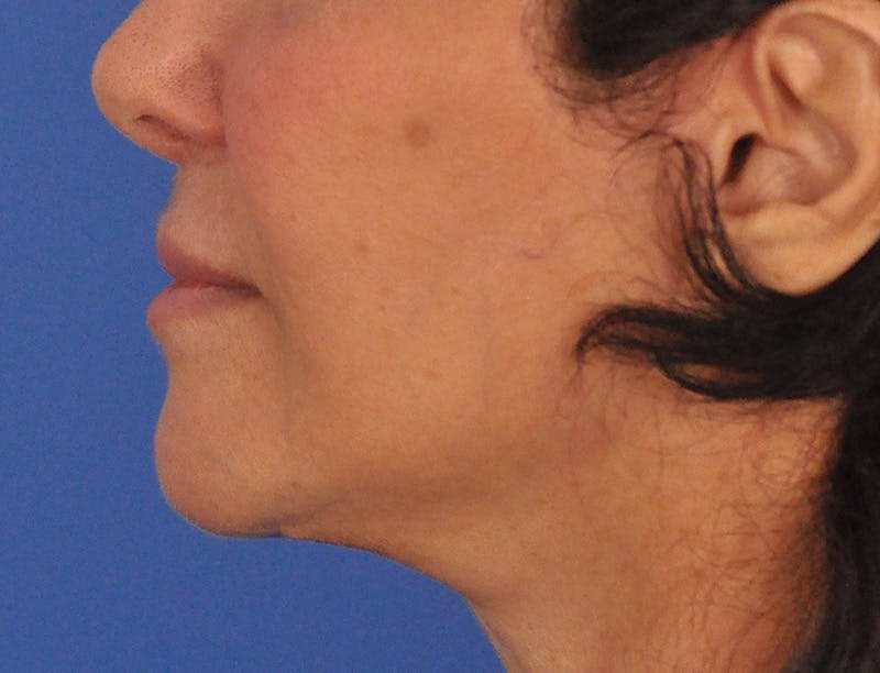 Lip Filler Before & After Gallery - Patient 216049 - Image 8