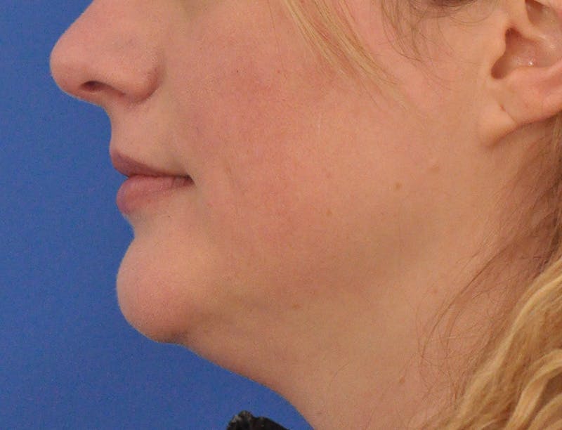 Lip Filler Before & After Gallery - Patient 310772 - Image 9