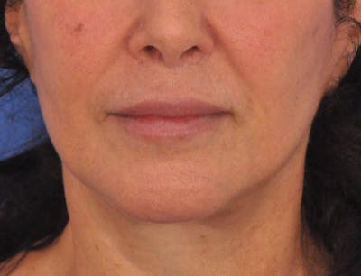Lip Filler Before & After Gallery - Patient 216049 - Image 2