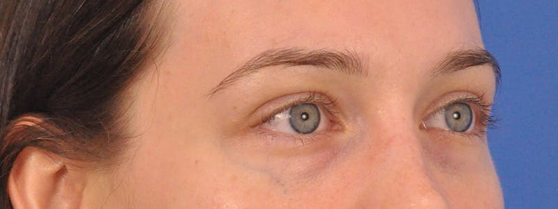 Tear Trough Filler Before & After Gallery - Patient 401813 - Image 3