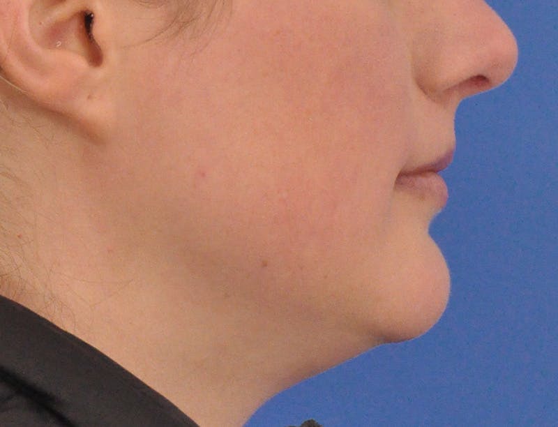 Lip Filler Before & After Gallery - Patient 310772 - Image 5