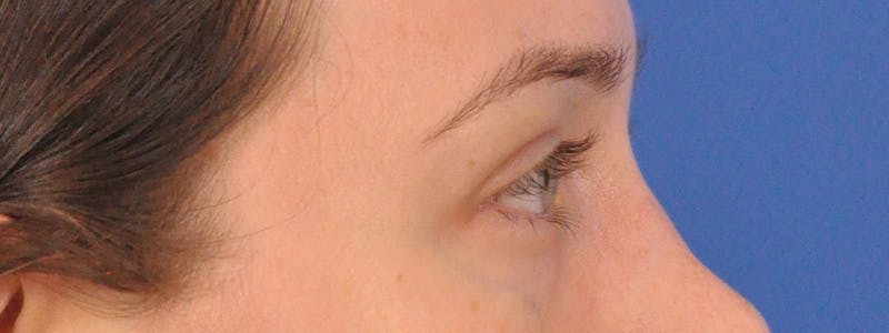 Tear Trough Filler Before & After Gallery - Patient 401813 - Image 5