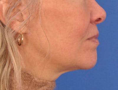 Chin Filler Before & After Gallery - Patient 408108 - Image 2