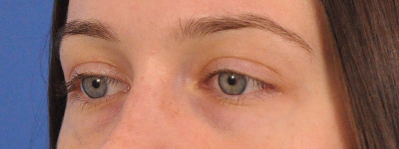 Tear Trough Filler Before & After Gallery - Patient 401813 - Image 7