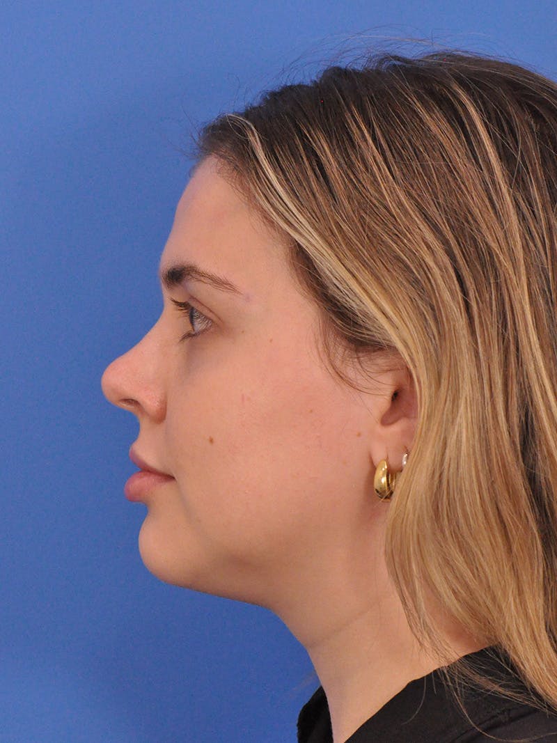 Chin Filler Before & After Gallery - Patient 170133 - Image 10