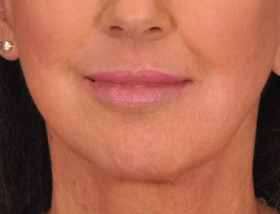 Lip Filler Before & After Gallery - Patient 947781 - Image 2