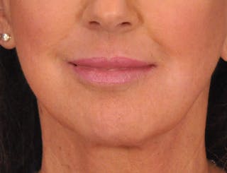 Lip Filler Before & After Gallery - Patient 947781 - Image 2