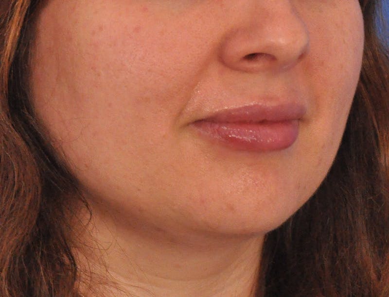 Lip Filler Before & After Gallery - Patient 296687 - Image 4