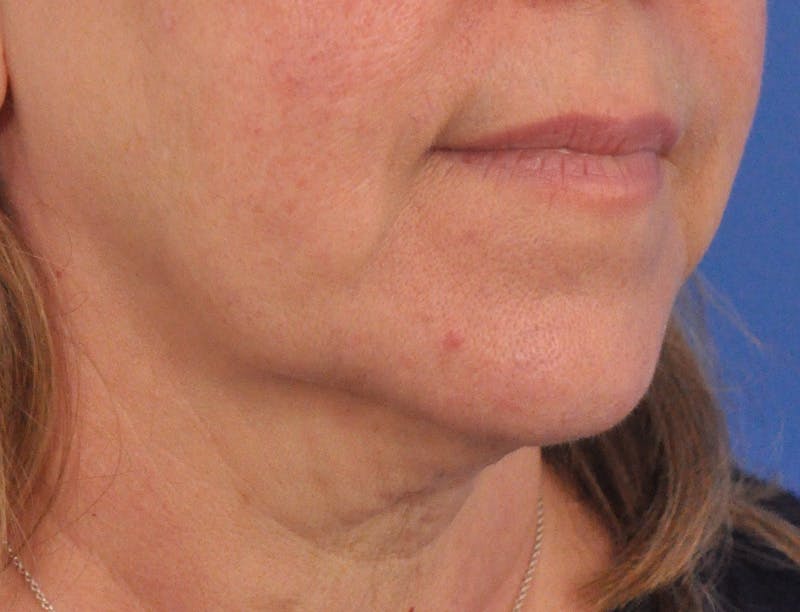 Lip Filler Before & After Gallery - Patient 237994 - Image 3