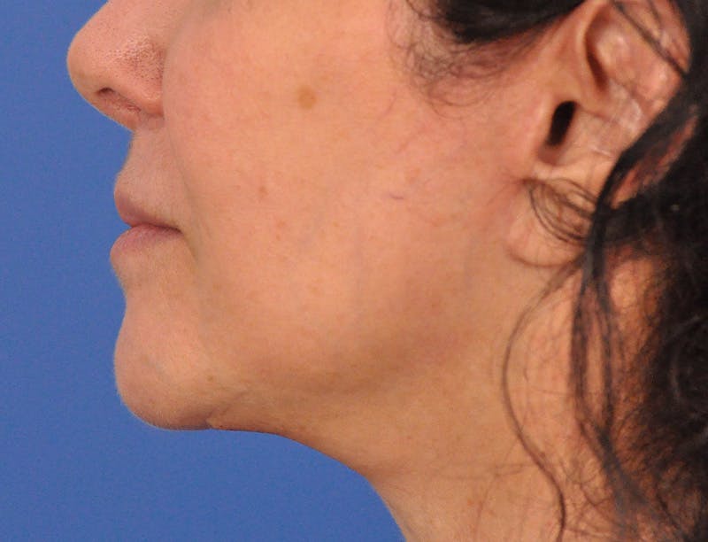 Lip Filler Before & After Gallery - Patient 216049 - Image 7