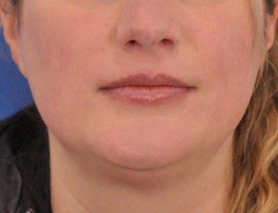 Lip Filler Before & After Gallery - Patient 310772 - Image 1