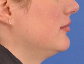 Lip Filler Before & After Gallery - Patient 310772 - Image 6