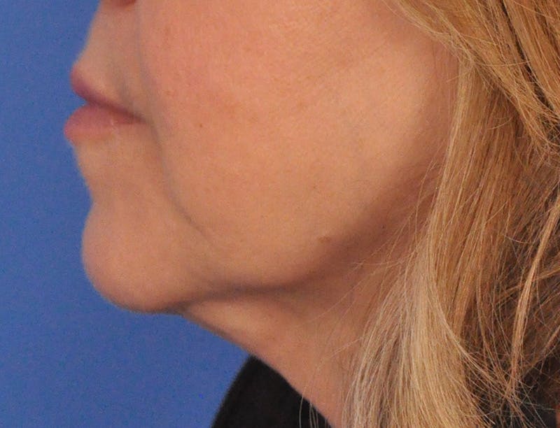 Lip Filler Before & After Gallery - Patient 237994 - Image 10