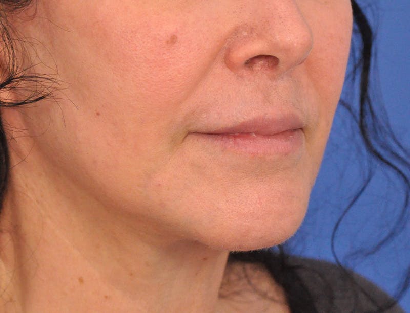 Lip Filler Before & After Gallery - Patient 216049 - Image 3