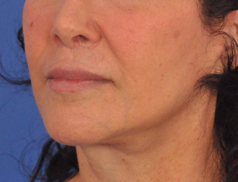 Lip Filler Before & After Gallery - Patient 216049 - Image 6