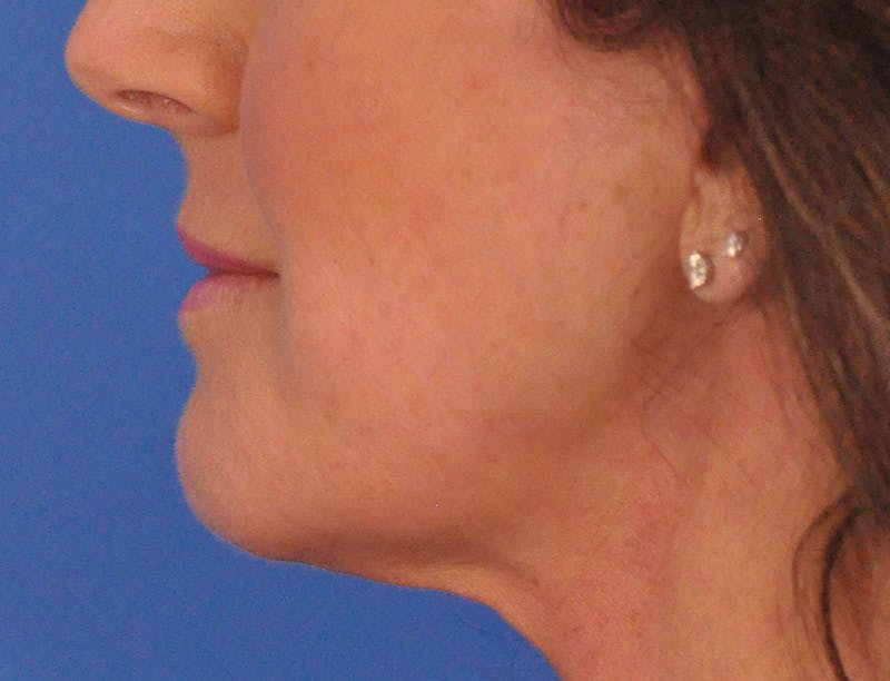 Lip Filler Before & After Gallery - Patient 947781 - Image 7
