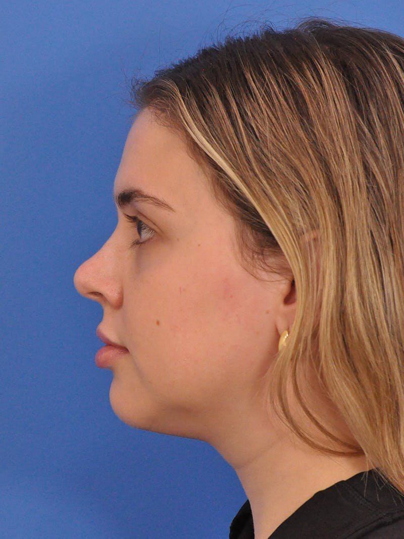 Chin Filler Before & After Gallery - Patient 170133 - Image 9