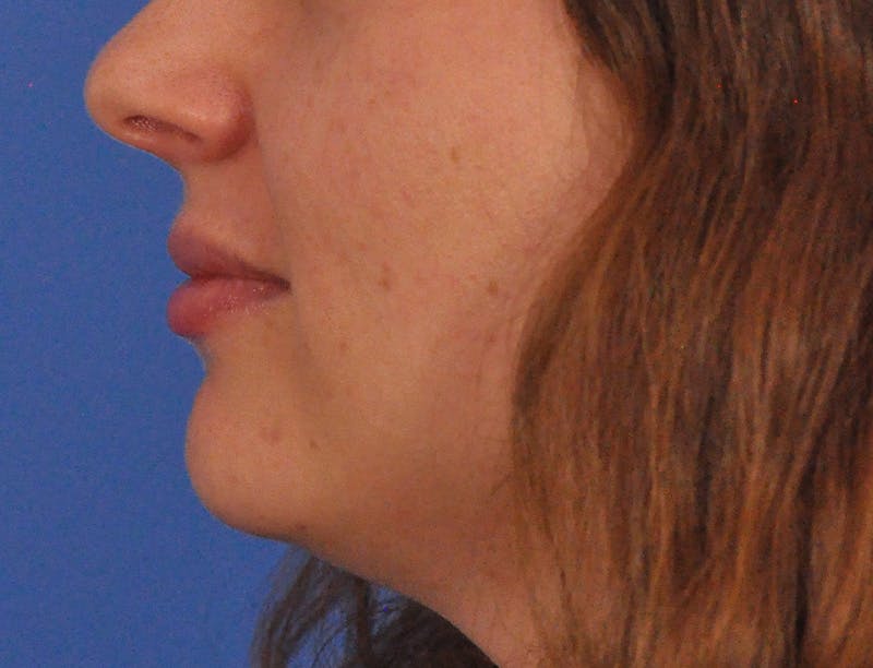 Lip Filler Before & After Gallery - Patient 296687 - Image 10