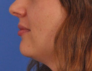 Lip Filler Before & After Gallery - Patient 296687 - Image 10