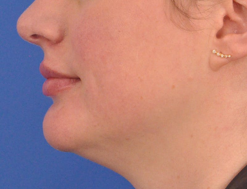 Lip Filler Before & After Gallery - Patient 310772 - Image 10