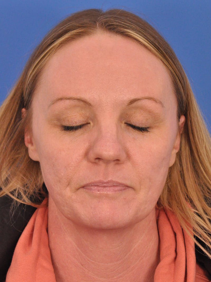 Acne Scars Before & After Gallery - Patient 147868 - Image 1