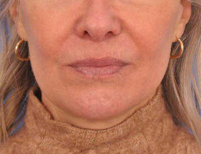 Lip Filler Before & After Gallery - Patient 325554 - Image 2