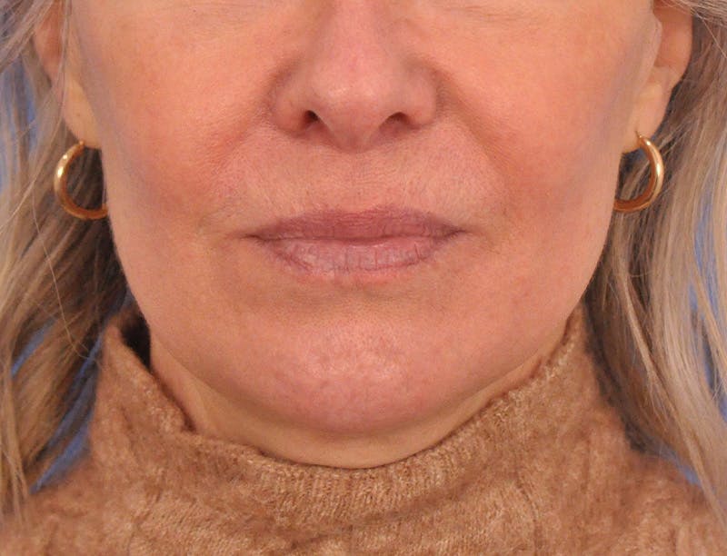 Lip Filler Before & After Gallery - Patient 325554 - Image 2