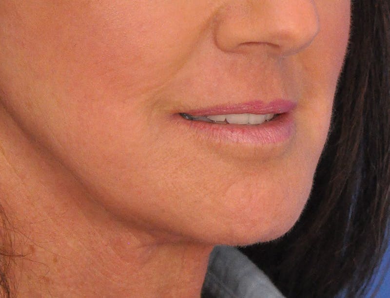 Lip Filler Before & After Gallery - Patient 947781 - Image 3