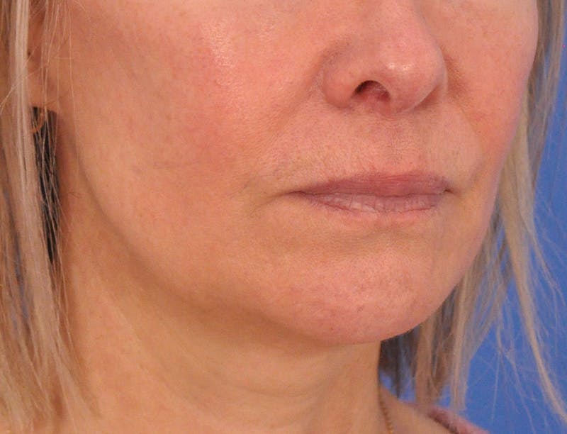 Lip Filler Before & After Gallery - Patient 325554 - Image 3