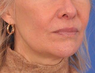 Lip Filler Before & After Gallery - Patient 325554 - Image 4