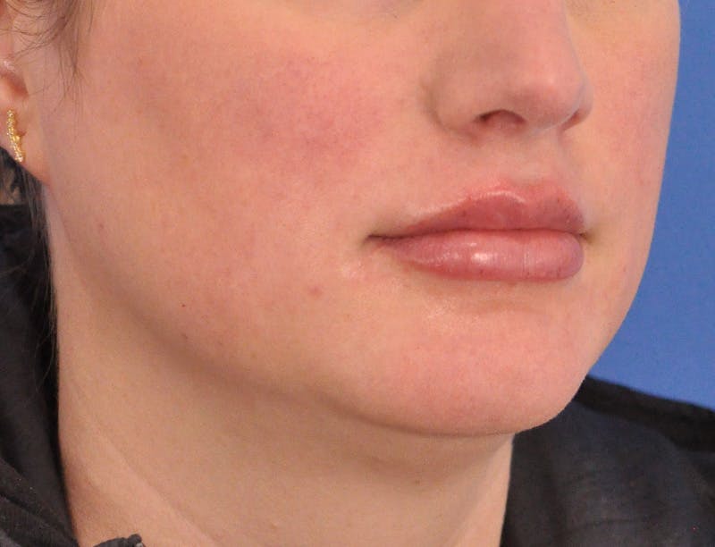 Lip Filler Before & After Gallery - Patient 310772 - Image 4
