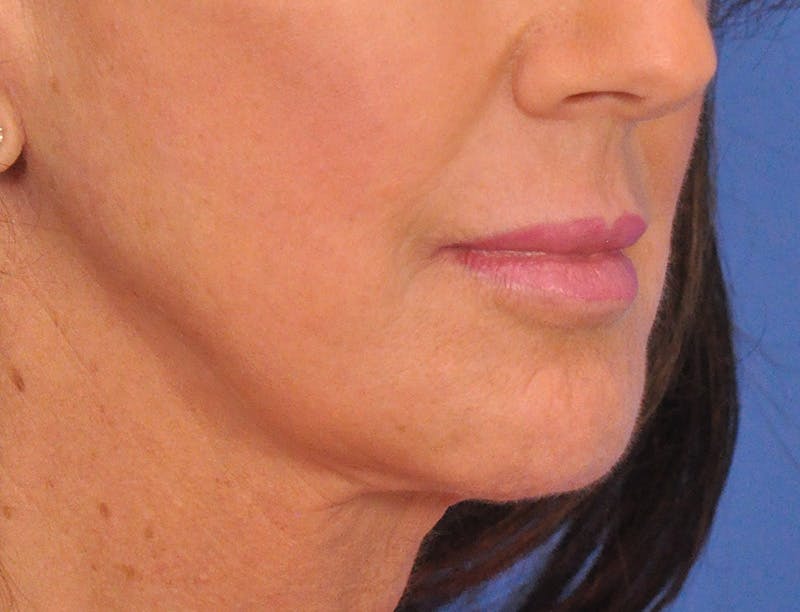 Lip Filler Before & After Gallery - Patient 947781 - Image 4