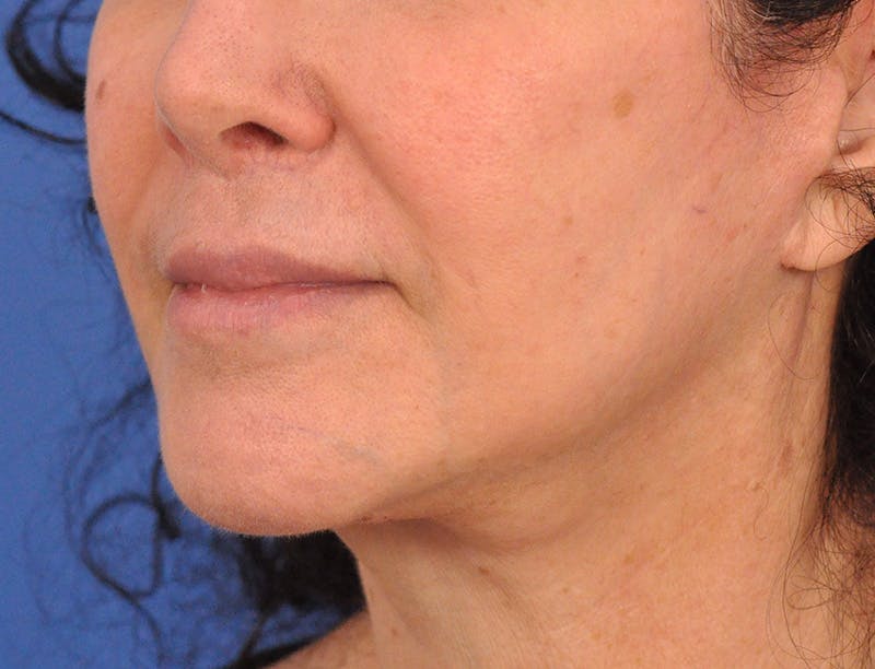 Lip Filler Before & After Gallery - Patient 216049 - Image 5