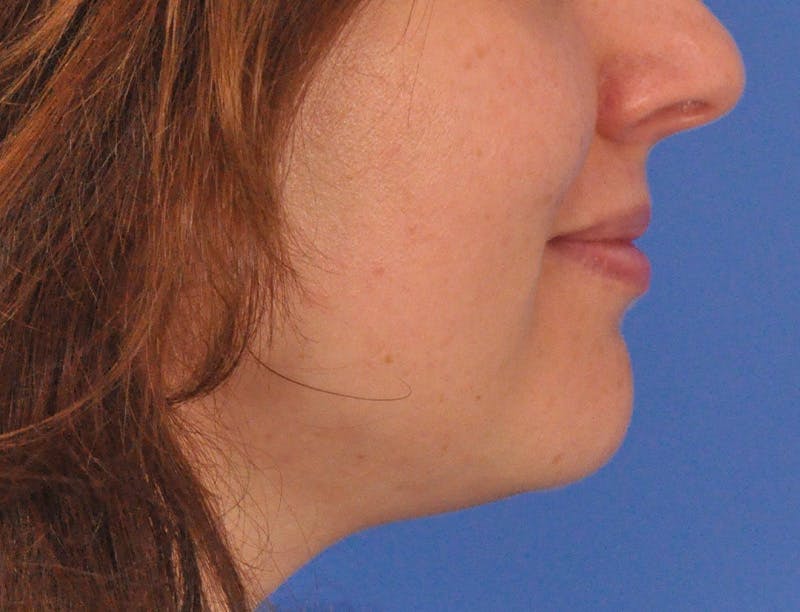 Lip Filler Before & After Gallery - Patient 296687 - Image 5