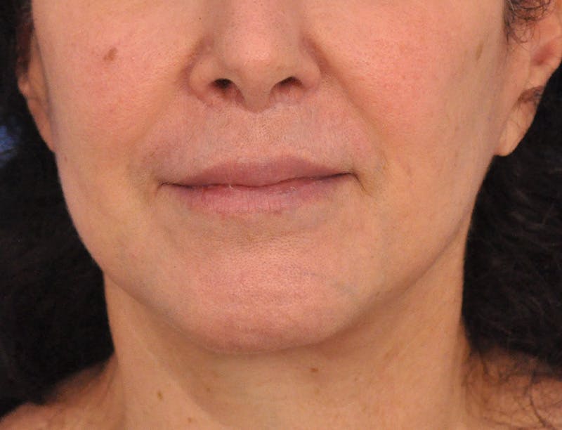Lip Filler Before & After Gallery - Patient 216049 - Image 1